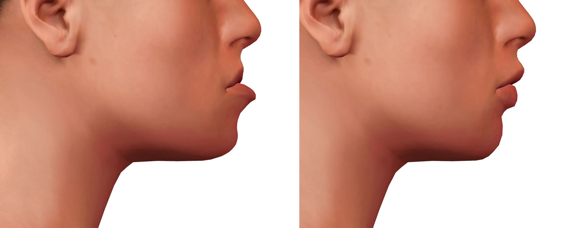 Torrance CA Jaw Straightening Alignment Surgery Palos Verdes